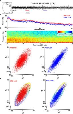Do Complexity Measures of Frontal EEG Distinguish Loss of Consciousness in Geriatric Patients Under Anesthesia?